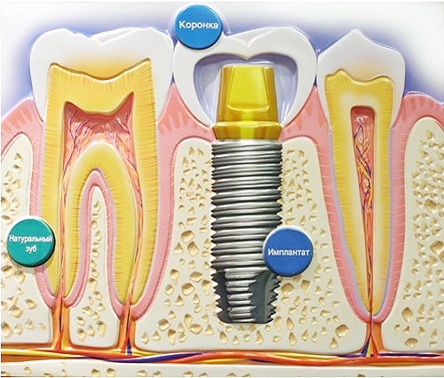 zubnaya-implantaciya.jpg