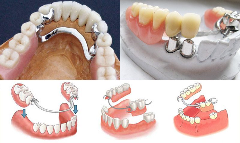 syemny-protez-zubov.jpg