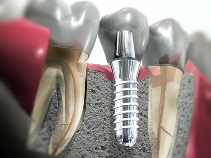 uslugi-implantacii-zubov.jpg